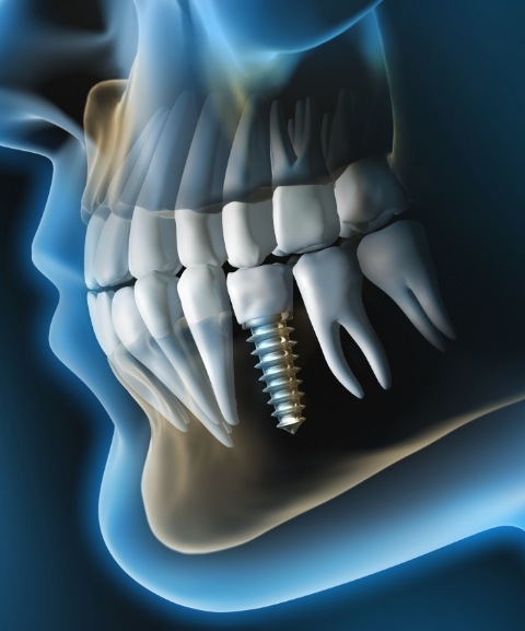 Animated jaw and teeth with dental implant supported dental crown in place