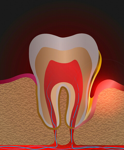 Illustration of periodontal pocket next to tooth