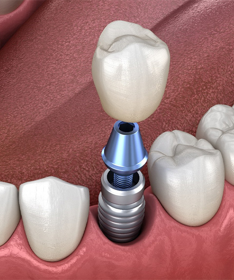 Closeup of dental implant placement in Mayfield Heights