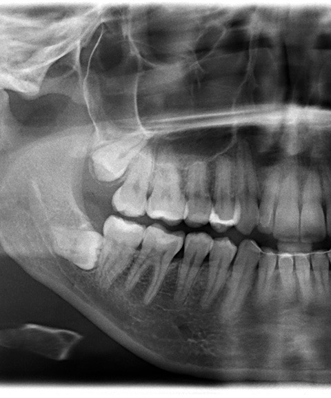 Mayfield Heights patient with jaw discomfort from wisdom teeth