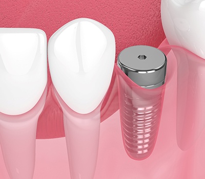 Digital illustration of a dental implant