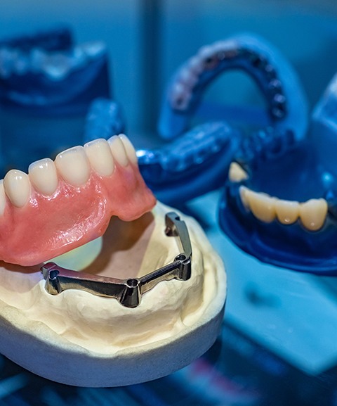 Example of Implant dentures from Ross Periodontics