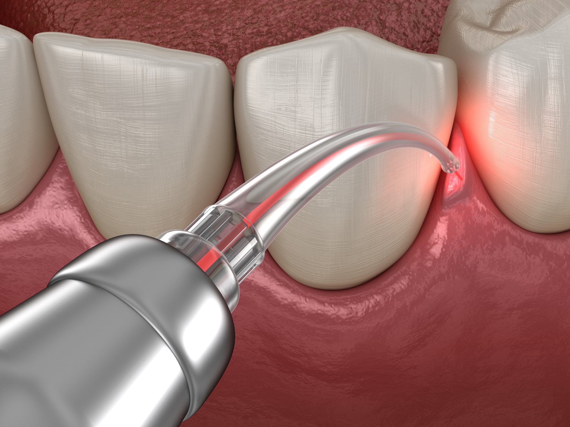 How Much Does Laser Gum Therapy Cost