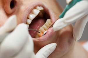 Dentist using soft tissue laser on patient